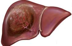Как избежать рака печени: новые рекомендации от современных ученых
