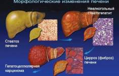 Что такое фиброз печени?