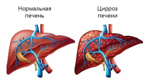 Цирроз печени